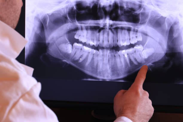 Best Emergency Wisdom Tooth Extraction in Hayward, CA
