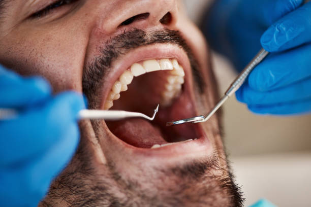 Best Emergency Treatment for Oral Infections in Hayward, CA